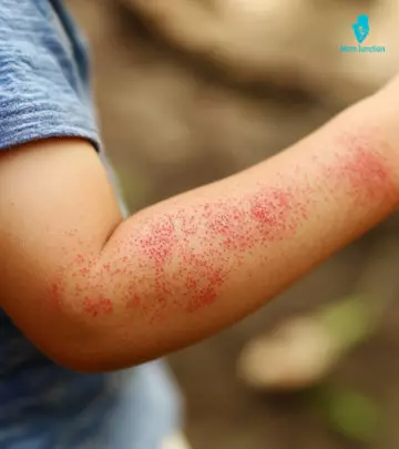 A Kid Suffering From Roseola