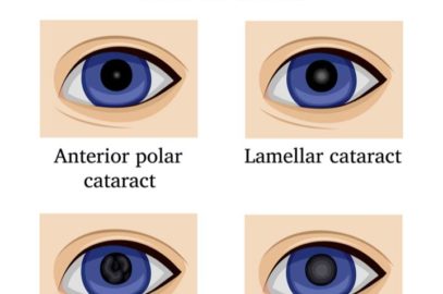Congenital Cataract: Types, Causes, Symptoms And Treatment