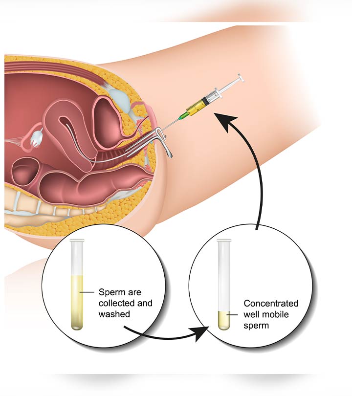 Intrauterine Insemination: What It Is, Risks & Success Rate