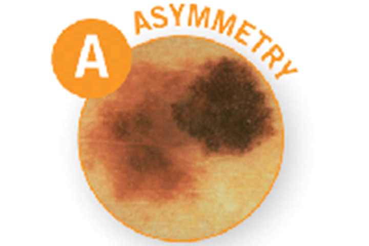 A - Asymmetry