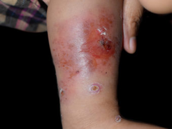 Cellulitis In Children: Signs, Causes, Diagnosis & Treatment