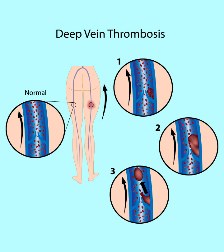 Deep Vein Thrombosis (DVT) In Pregnancy: Symptoms And Treatment 