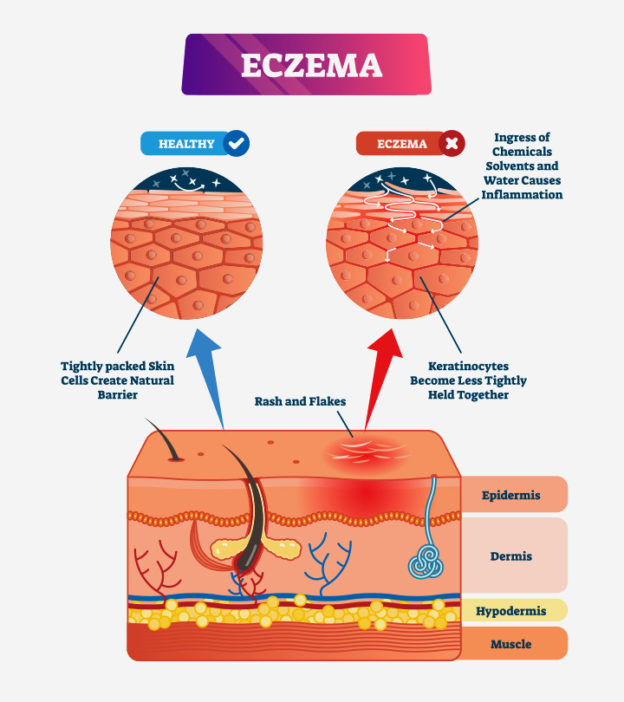 Eczema During Pregnancy: Causes, Treatment And Home Remedies