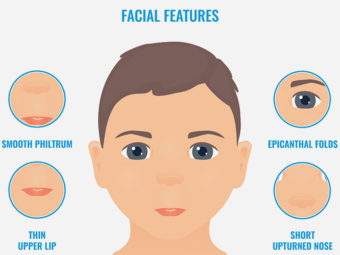 Fetal Alcohol Syndrome (FAS): Causes, Symptoms And Treatment