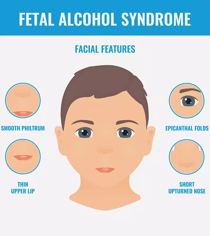 Fetal Alcohol Syndrome Causes, Symptoms And Treatment