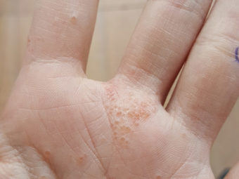 Causes & Signs Of Hand, Foot, And Mouth Disease In Pregnancy