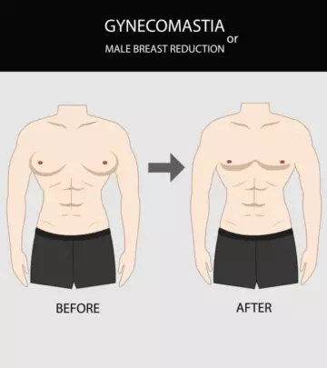 Gynecomastia In Teens: Causes, Signs, Diagnosis & Treatment