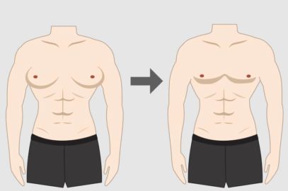 Gynecomastia In Teens: Causes, Symptoms, Diagnosis, And Treatment