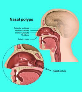 Nasal Polyps In Children: Signs, Causes, Risks, And Treatment