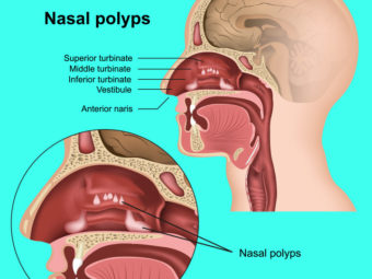 Nasal Polyposis In Children: Causes, Symptoms, Treatment And Prevention