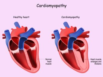 Postpartum Cardiomyopathy (PPCM): Symptoms And Treatment