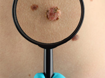 Skin Cancer In Children: Types, Pictures, Symptoms And Treatment