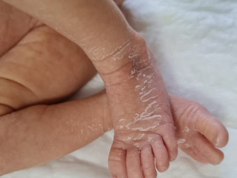 Skin Peeling In Newborns