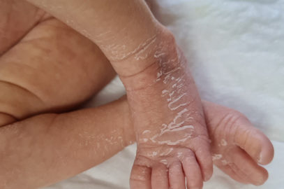 Skin Peeling In Newborns: Is It Normal, Causes, And Remedies