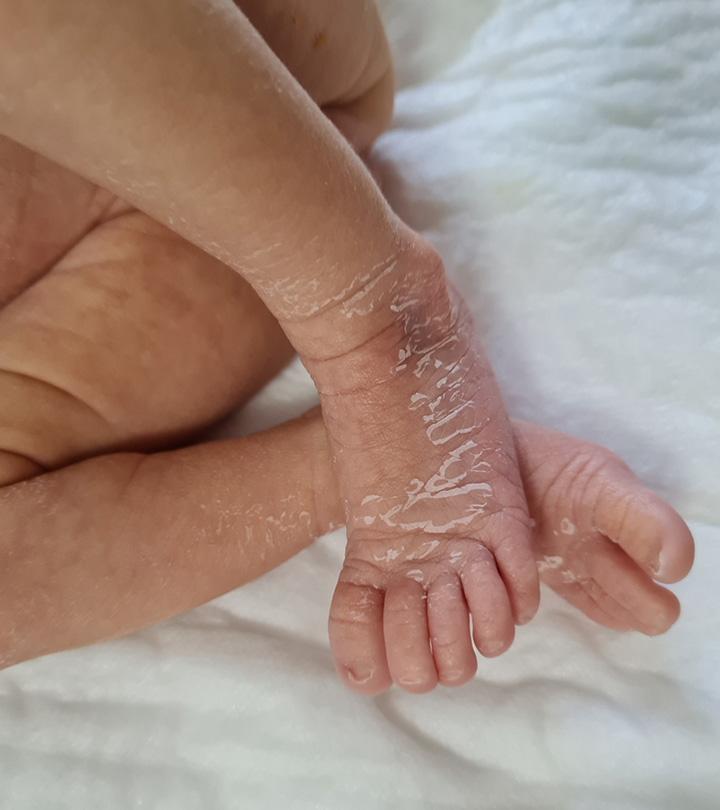 What Causes Newborn Skin Peeling And What S The Treatment