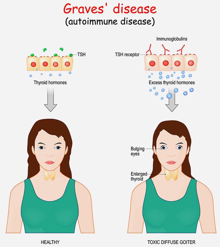 How To Diagnose And Treat Graves' Disease In Children?