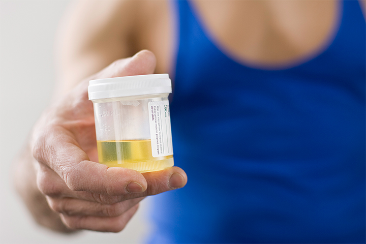 Urine tests may help in the diagnosis of gynecomastia.