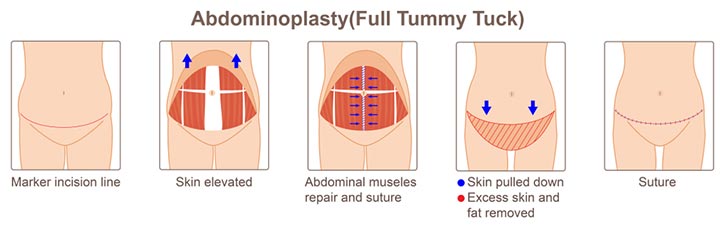 Process of full tummy tuck after C-section