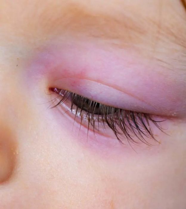 शिशुओं में सूजी हुई आंख - कारण व उपाय | Shishu Mein Suji Hui Aankh