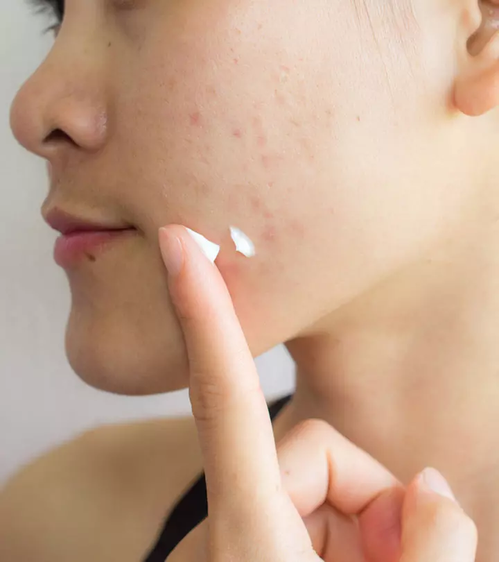 Acne When Pregnant Causes, Treatment and Home Remedies