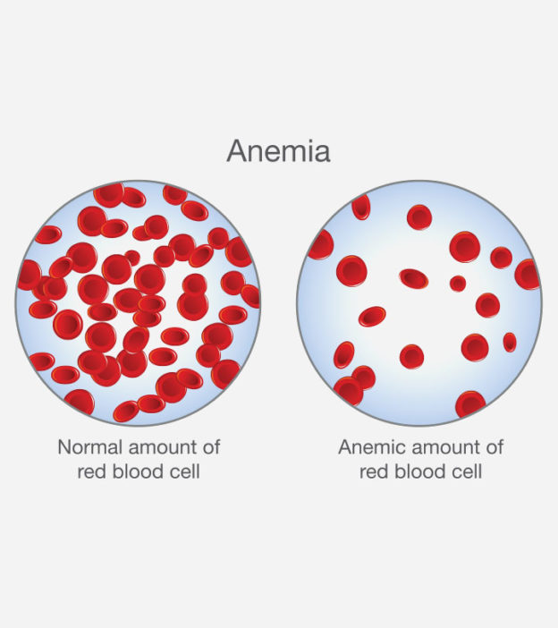 Anemia In Children: Types, Symptoms, Causes And Treatment