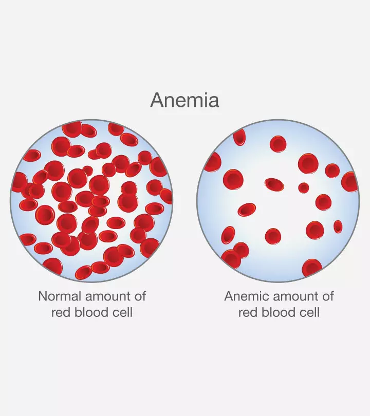 Anemia In Children Types, Causes, Symptoms, And Treatment