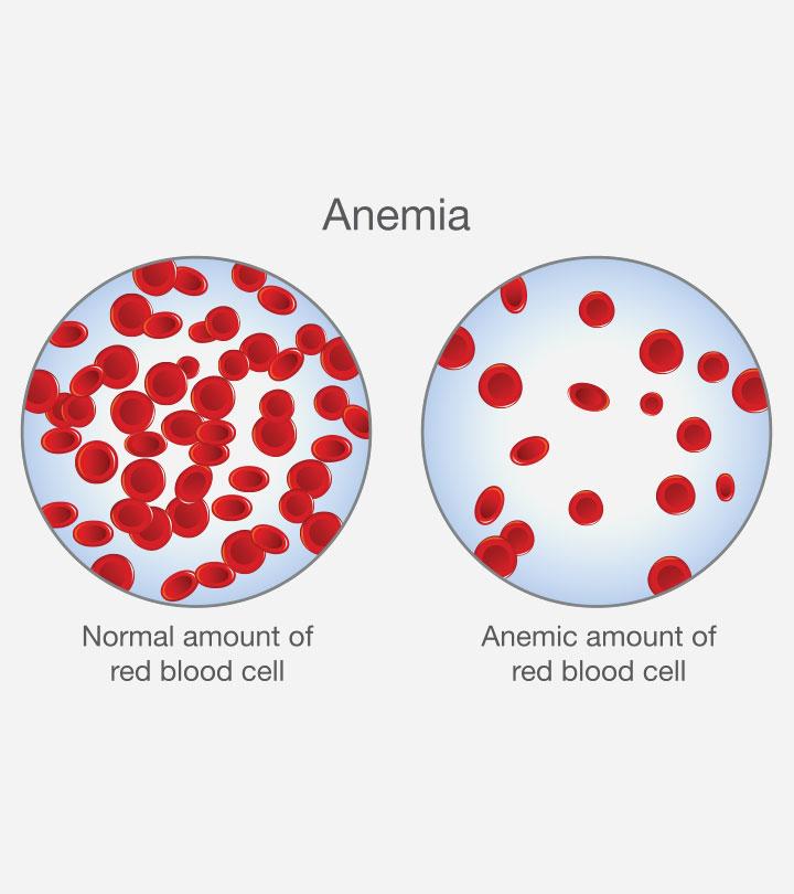 Anemia In Children Types Symptoms Causes And Treatment