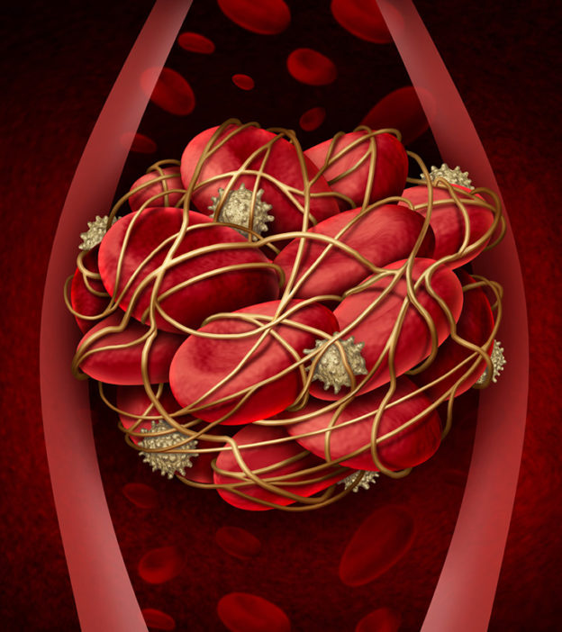 Blood Clots In Pregnancy: Types, Symptoms, Risks & Treatment