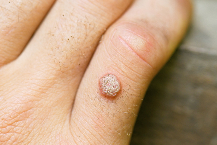 Common warts in babies