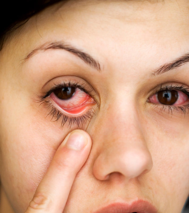 Conjunctivitis (Pink Eye) In Pregnancy: Symptoms, Causes, And Treatment