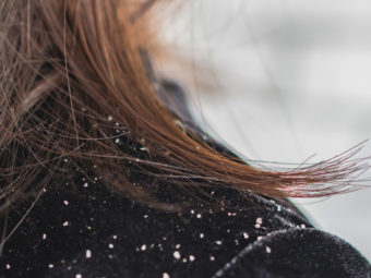Dandruff During Pregnancy Causes, Treatment