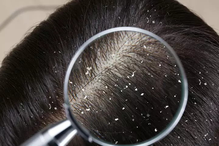 Dandruff if not treated may cause hair loss in children.