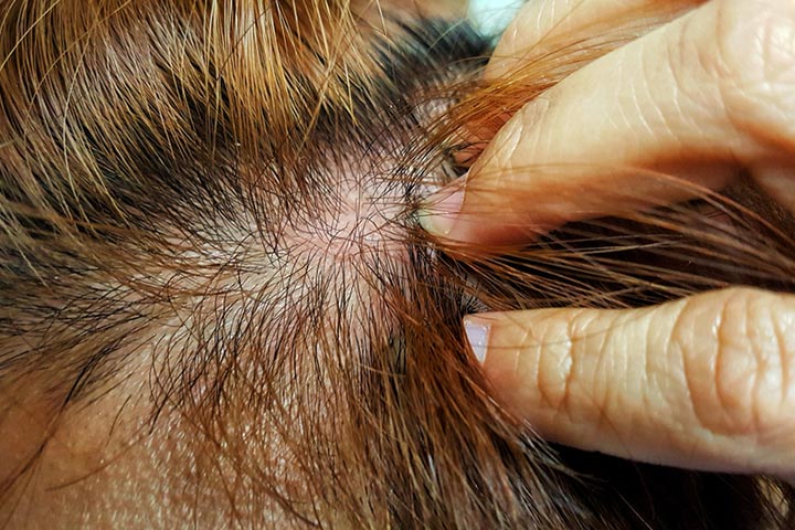 Fungal infection of the scalp during pregnancy