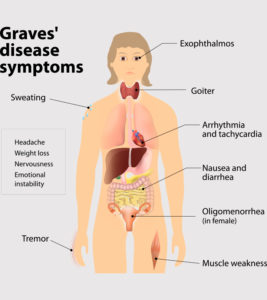 Graves Disease In Pregnancy: Causes, Symptoms And Treatment