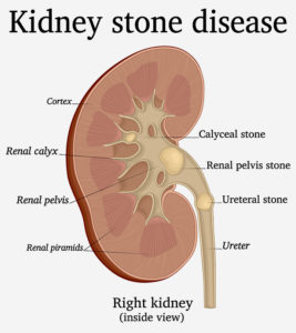Kidney Stones During Pregnancy: Symptoms, Risks & Treatment