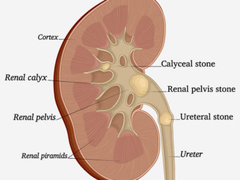 Kidney Stones During Pregnancy: Causes, Symptoms, And Treatment