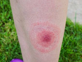 Lyme Disease During Pregnancy: Signs, Symptoms And Treatment