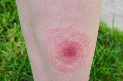Lyme Disease During Pregnancy: Signs, Symptoms And Treatment