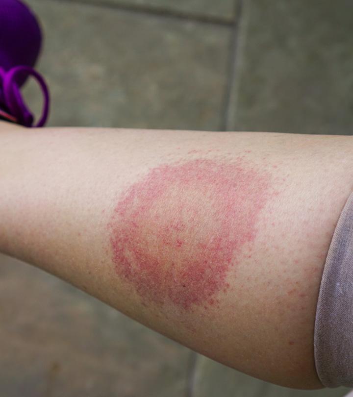 Symptoms Of Lyme Disease In Children And Its Prevention