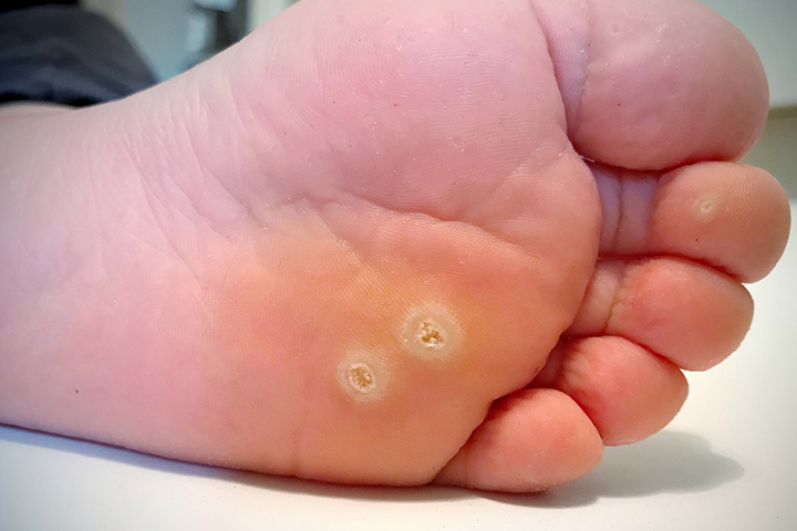 Palmar and plantar warts in babies