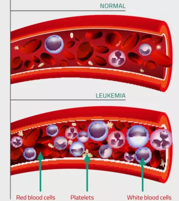 9 Symptoms Of Leukemia In Teens, Causes, Diagnosis & Treatment