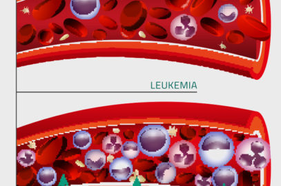 Teenage Leukemia: Symptoms, Causes, Treatment And Prevention