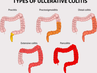 7 Causes Of Ulcerative Colitis In Children, Signs And Treatment