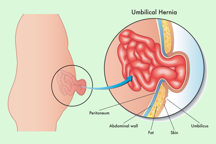 Umbilical hernia in pregnancy develops due to weak abdominal muscle
