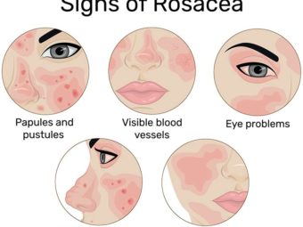 Rosacea In Children: Causes, Symptoms, Treatment And Prevention