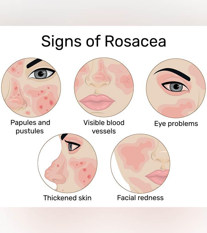 can-a-child-get-rosacea-symptoms-treatment-and-prevention