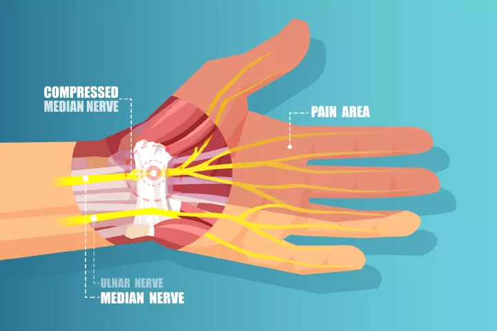 This additional fluid increases pressure and swelling in the blood vessels throughout your body, including the carpal tunnel of the wrist.