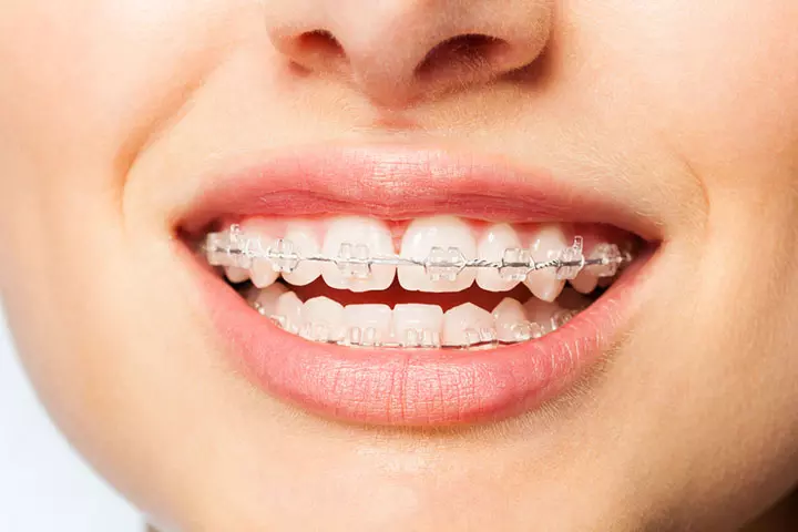 Ceramic braces for kids