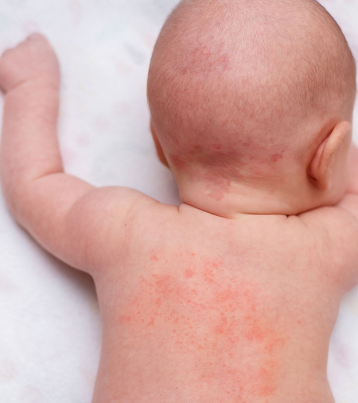 Heat Rash In Babies Types Symptoms Treatment And Prevention 