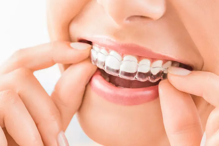 Брекеты Invisalign для детей